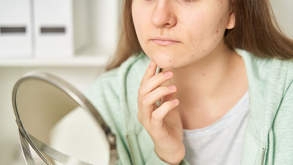 SKIN BREAKOUTS TREATMENT
