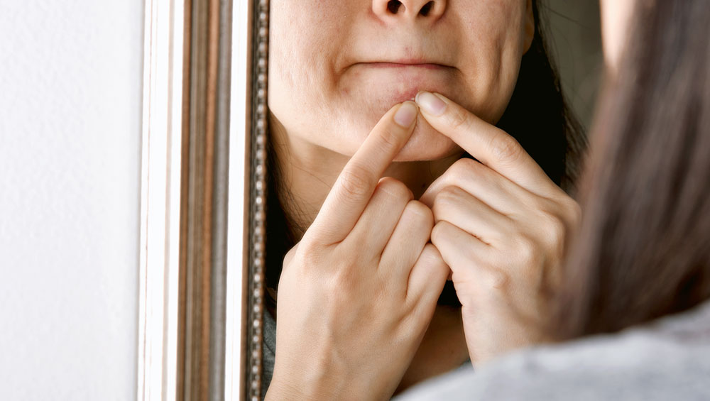 acne and blemishes treatment