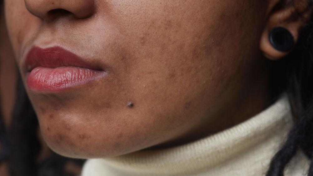 hyperpigmentation treatment